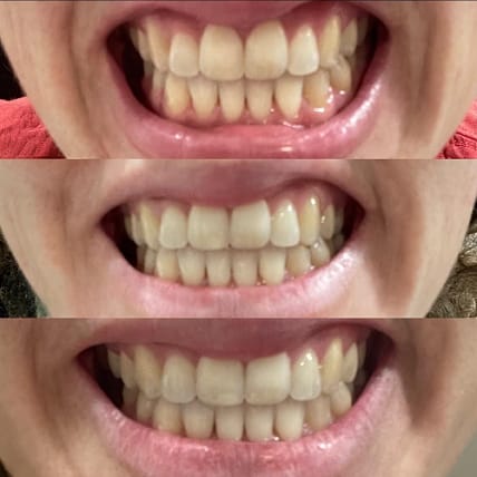 Customer photo review of LYSS Oil Pulling - kokosový olej na zuby