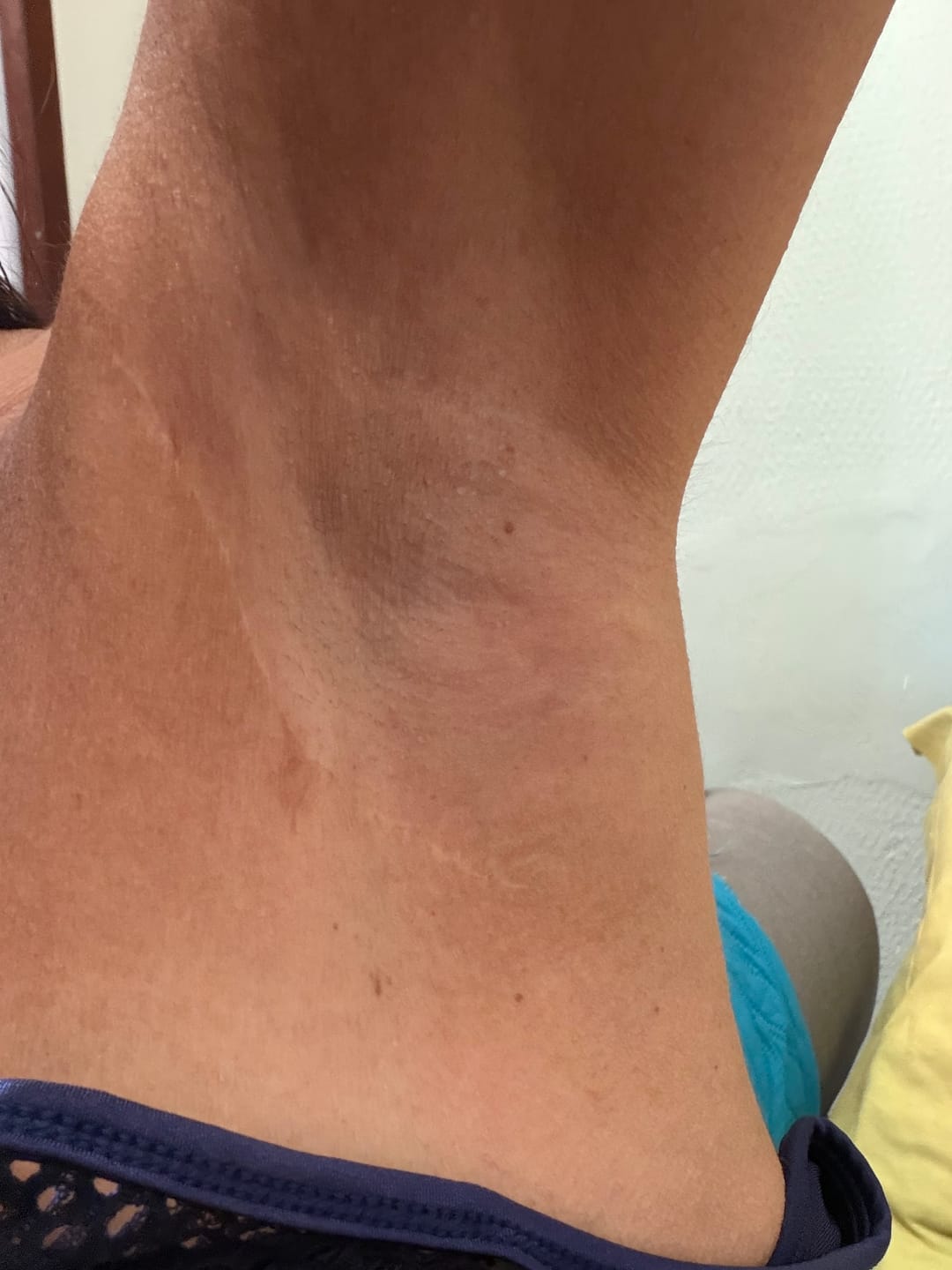 Customer photo review of Creme Clareador de Manchas – Melasma, Axilas, Virilha, Áreas Íntimas, Rosto e Corpo