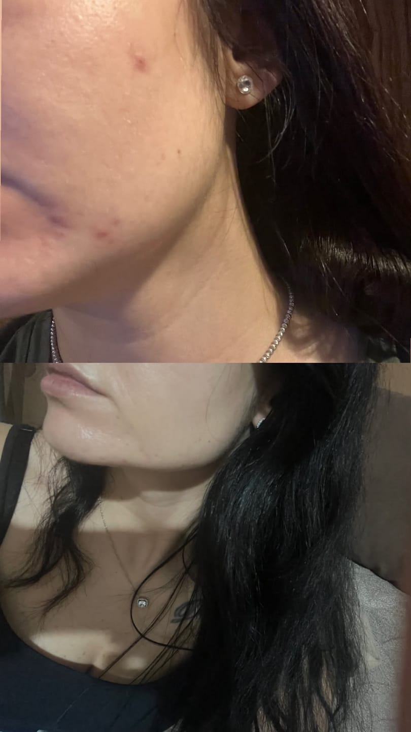 Customer photo review of Azelia+ | Азелаинов серум за петна и пъпки