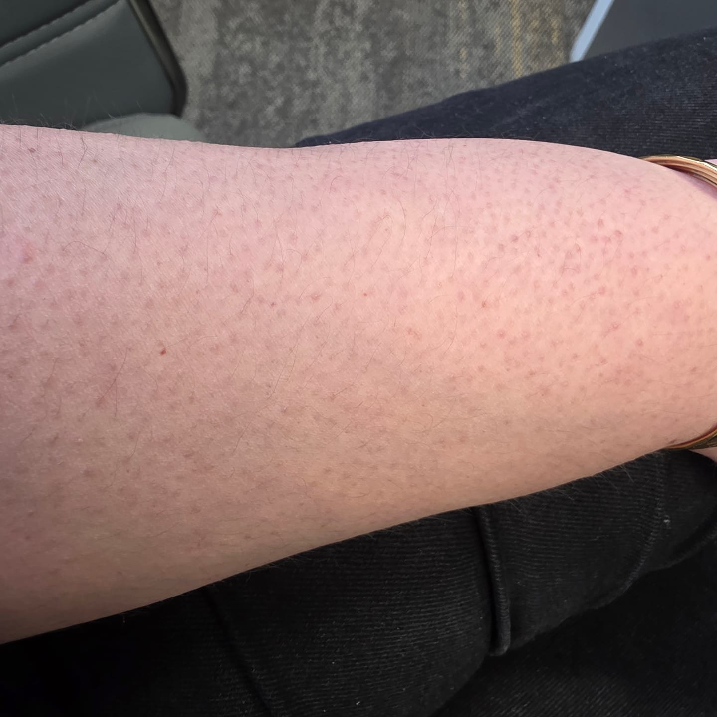 Customer photo review of Acne Clarifying Serum Body Wash