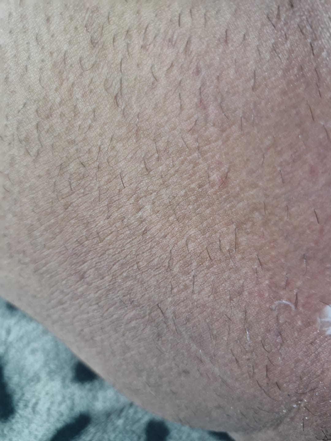 Customer photo review of Creme Clareador de Manchas – Melasma, Axilas, Virilha, Áreas Íntimas, Rosto e Corpo