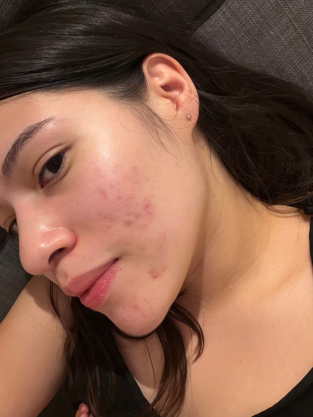 Customer photo review of A CONTROL - ACNÉ HORMONAL & RESISTENCIA A LA INSULINA