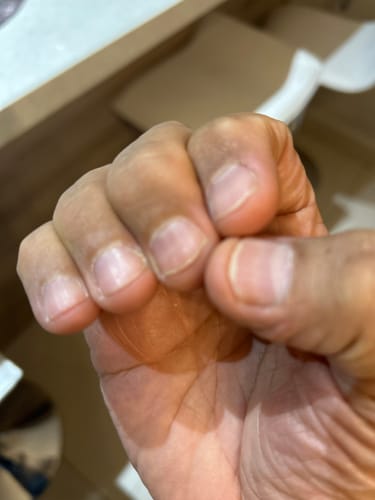 Customer photo review of MyCurePro® · Elimina hongos en pies y manos · 7 días