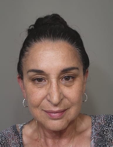Reviewer's face showing skin texture before completing the Micro Infusion System treatment.