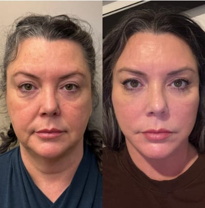 Customer photo review of Retinal Shot™ – Crema Viso Anti-Rughe Rassodante