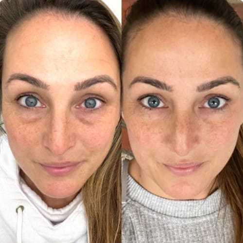 Customer photo review of Retinal Shot™ – Crema Viso Anti-Rughe Rassodante