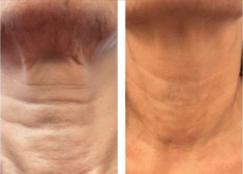 Customer photo review of Retinal Shot™ – Crema Viso Anti-Rughe Rassodante