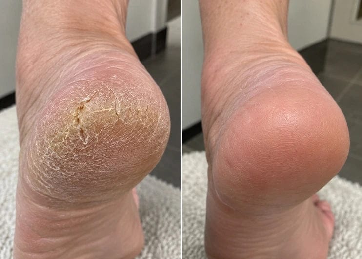 Customer photo review of Glass Foot File.
