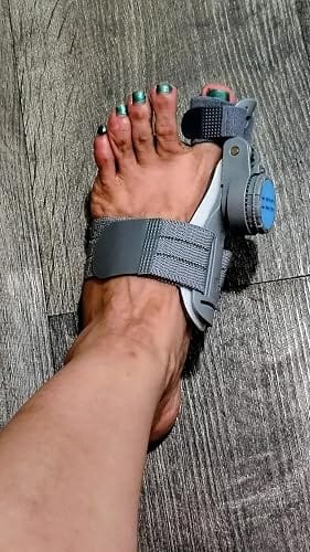 Customer photo review of FeetifFix Bunion Corrector – Adjustable Toe Alignment Support Brace (1 PCS)