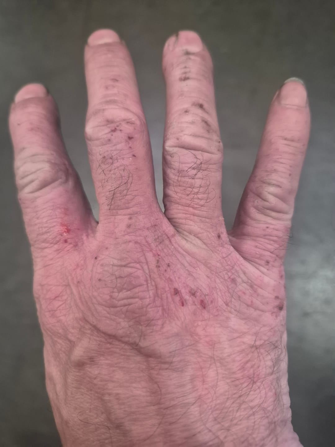 Customer photo review of Bioskin Duo Pack