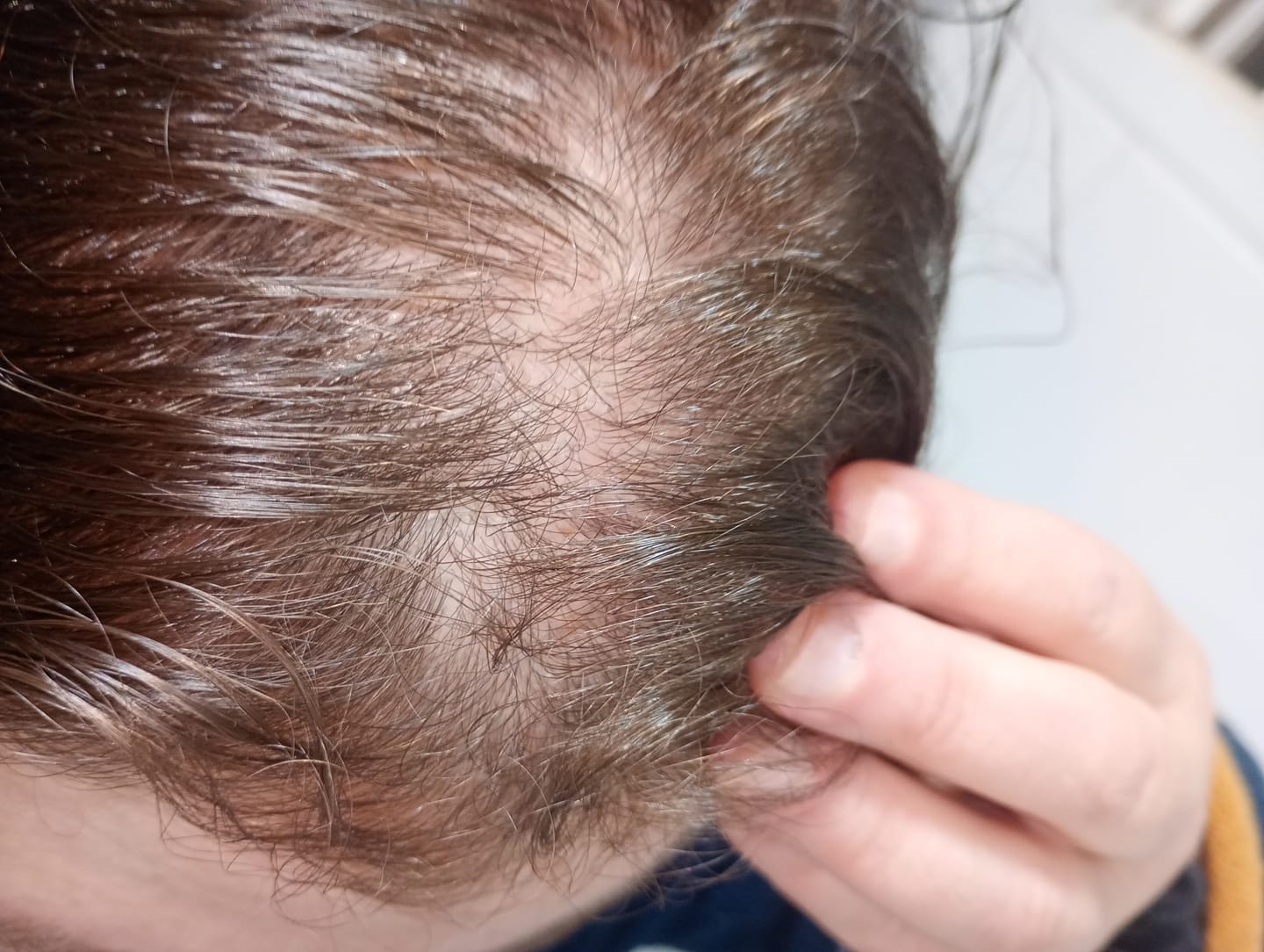 Customer photo review of Pack Anticaída de Cabello para 1 Mes