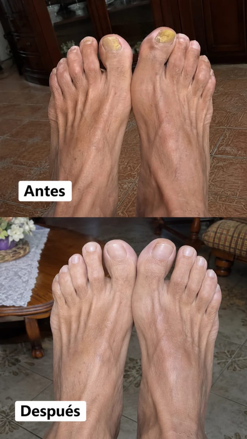 Customer photo review of Adiós a los hongos en las uñas con Onyvia V3