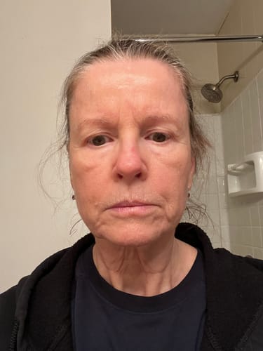 Customer's face showing skin texture before using the Seranova Micro Infusion System.