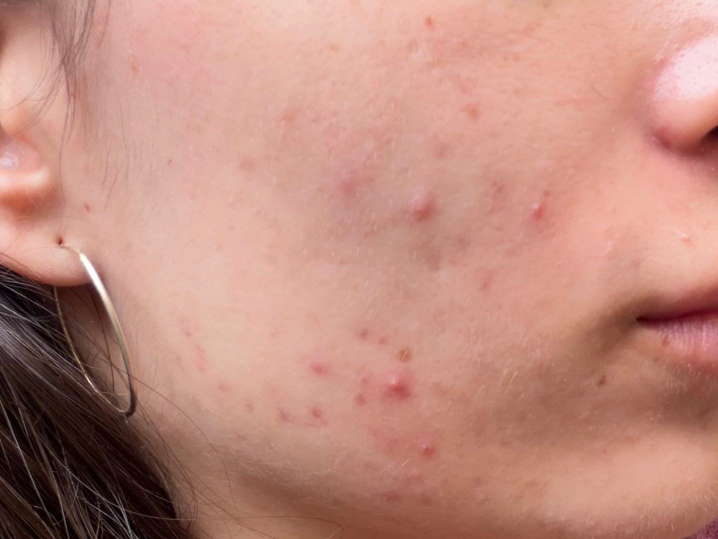 Customer photo review of A CONTROL - ACNÉ HORMONAL & RESISTENCIA A LA INSULINA