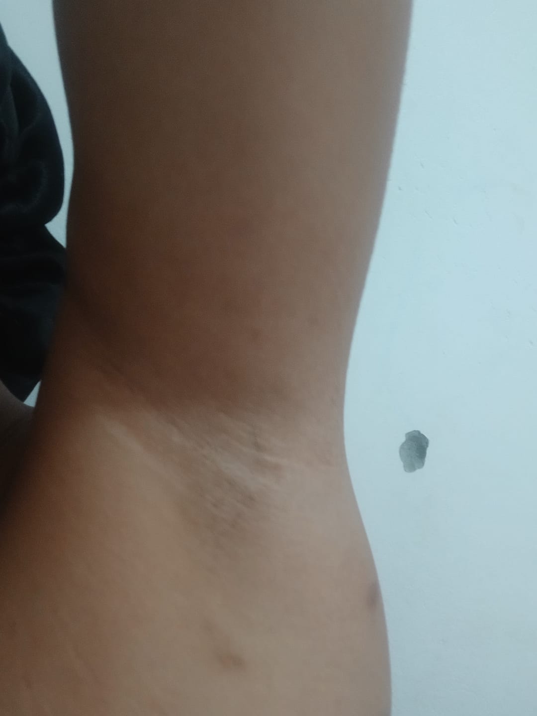 Customer photo review of Creme Clareador de Manchas – Melasma, Axilas, Virilha, Áreas Íntimas, Rosto e Corpo