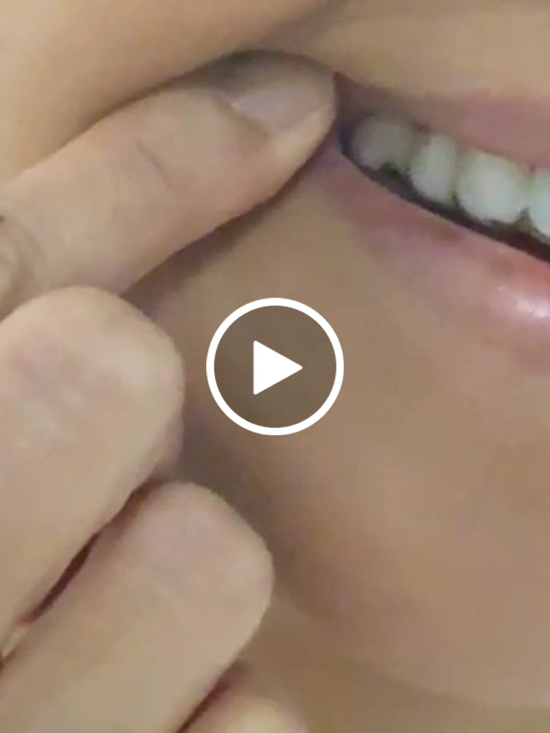 Customer video review of Custom Clear Removable Retainers