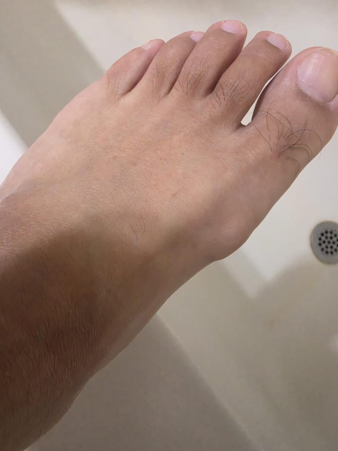 Customer photo review of FeetifFix Bunion Corrector – Adjustable Toe Alignment Support Brace (1 PCS)