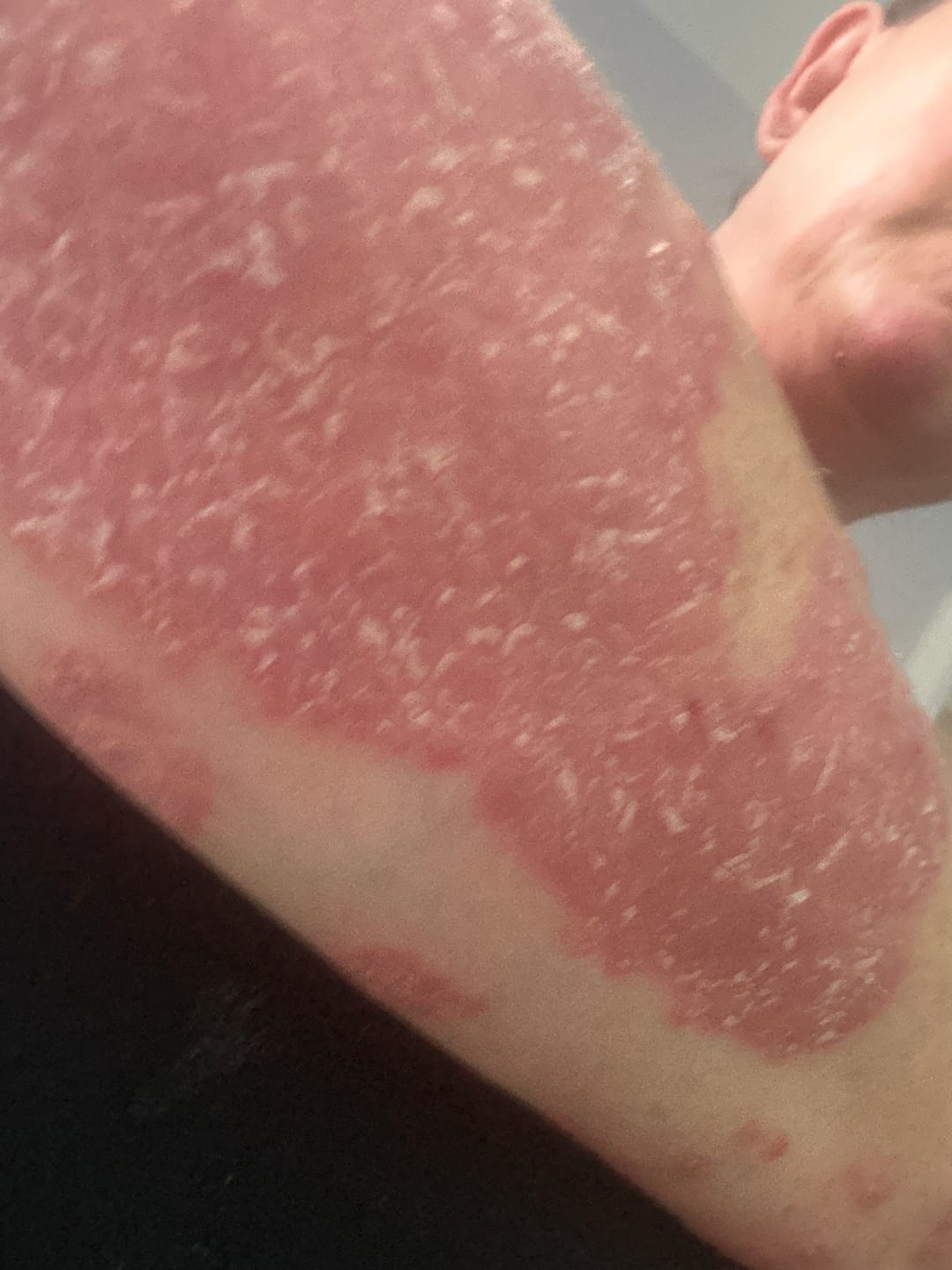 Customer photo review of Herbal Psoriasis & Eczema Relief Skin Cream