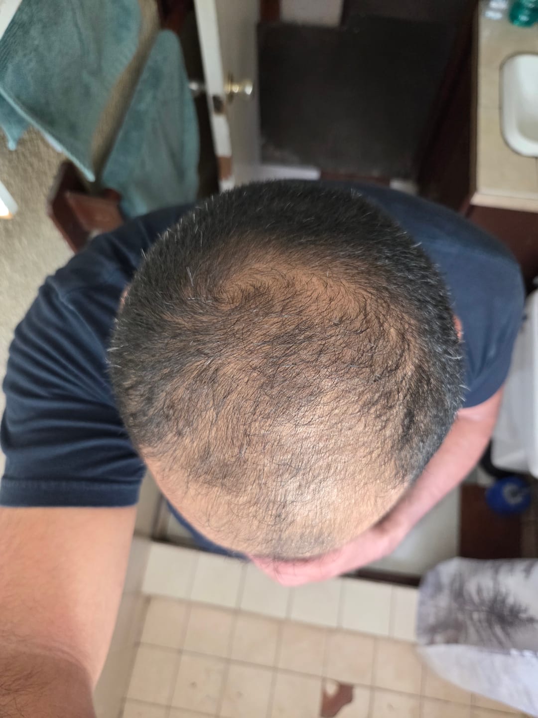 Customer photo review of Minoxidil 5 mg con 90 tabletas para 3 meses de tratamiento