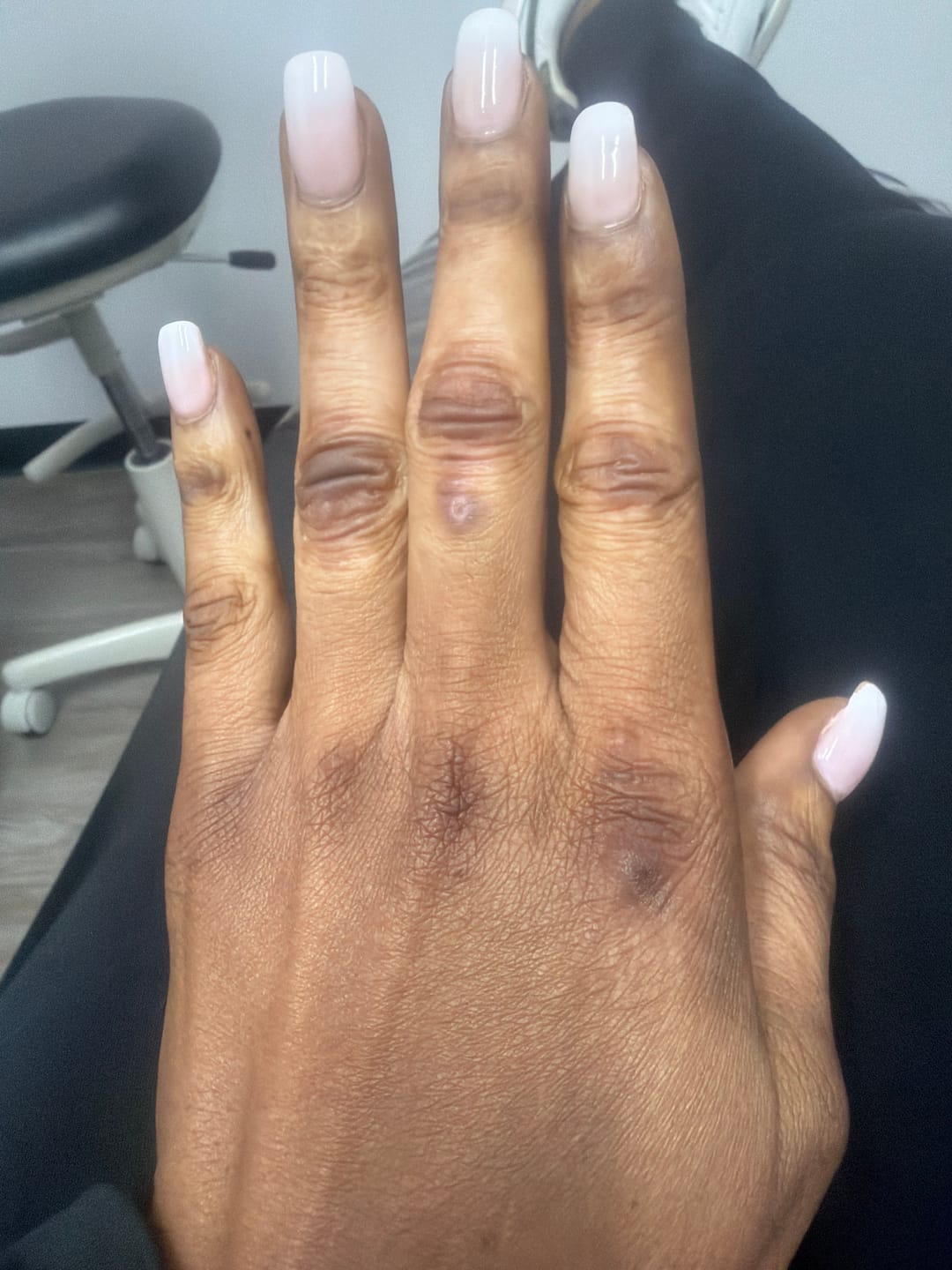 Customer photo review of Dark Knuckle Treatment (Results Driven )