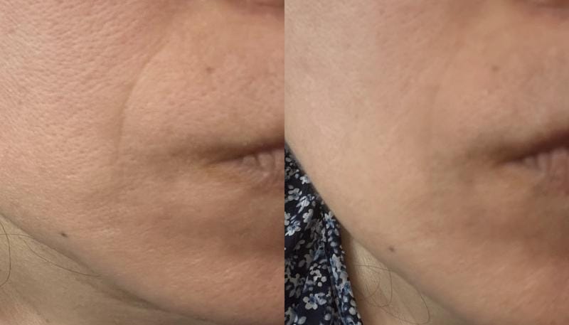 Customer photo review of Instant FIRMx® Peter Thomas Roth Tensor de Ojos Temporal