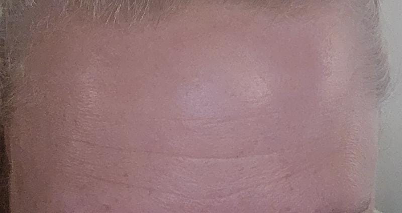 Customer photo review of Instant FIRMx® Peter Thomas Roth Tensor de Ojos Temporal