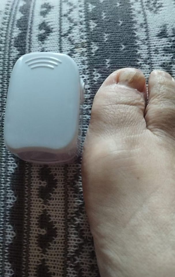 Customer photo review of Dispositivo Láser Micoval