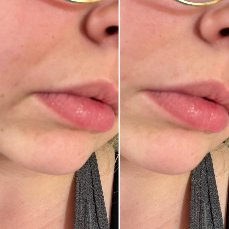 Customer photo review of Instant FIRMx® Peter Thomas Roth Tensor de Ojos Temporal