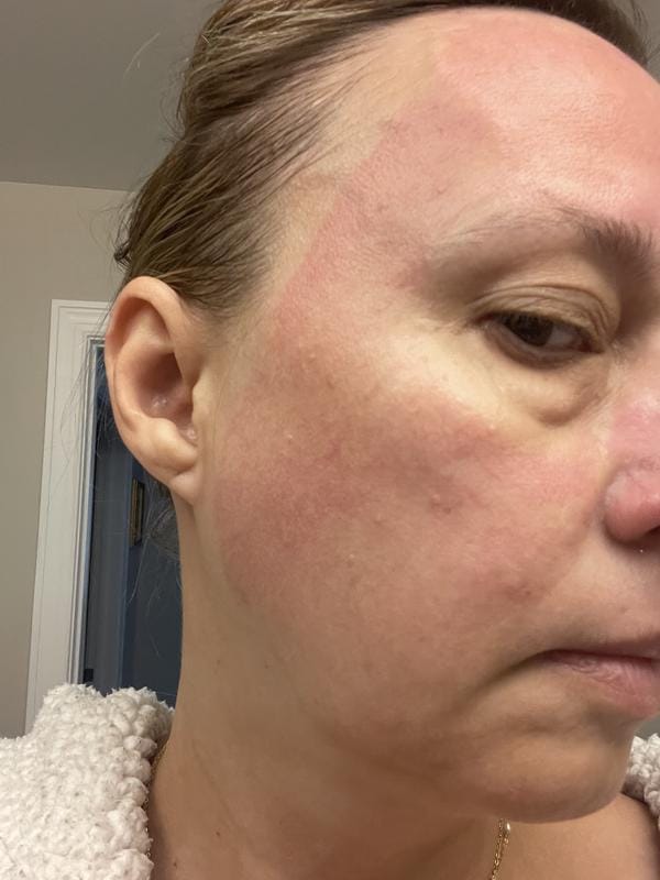 Customer photo review of Instant FIRMx® Peter Thomas Roth Tensor de Ojos Temporal
