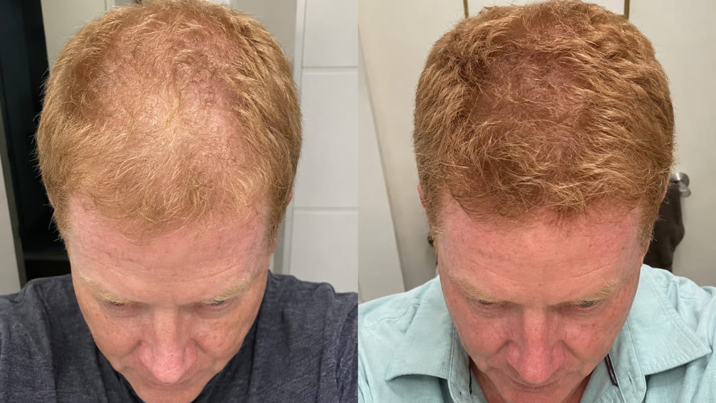 Customer photo review of Micro-Infusion System