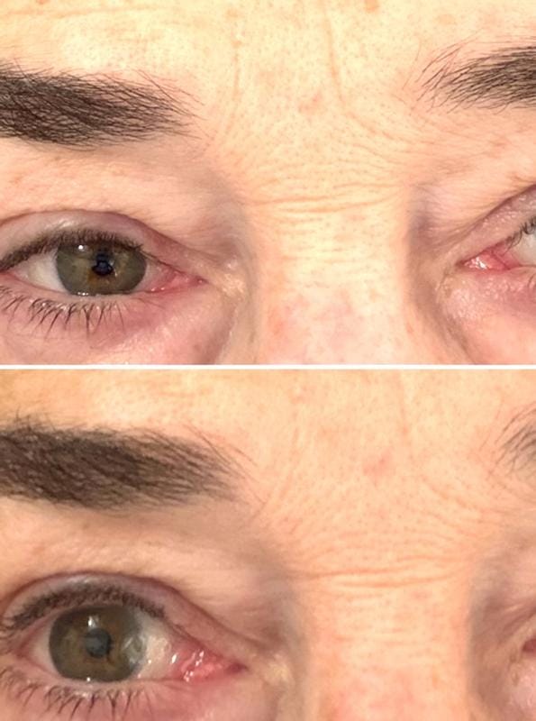 Customer photo review of Instant FIRMx® Peter Thomas Roth Tensor de Ojos Temporal