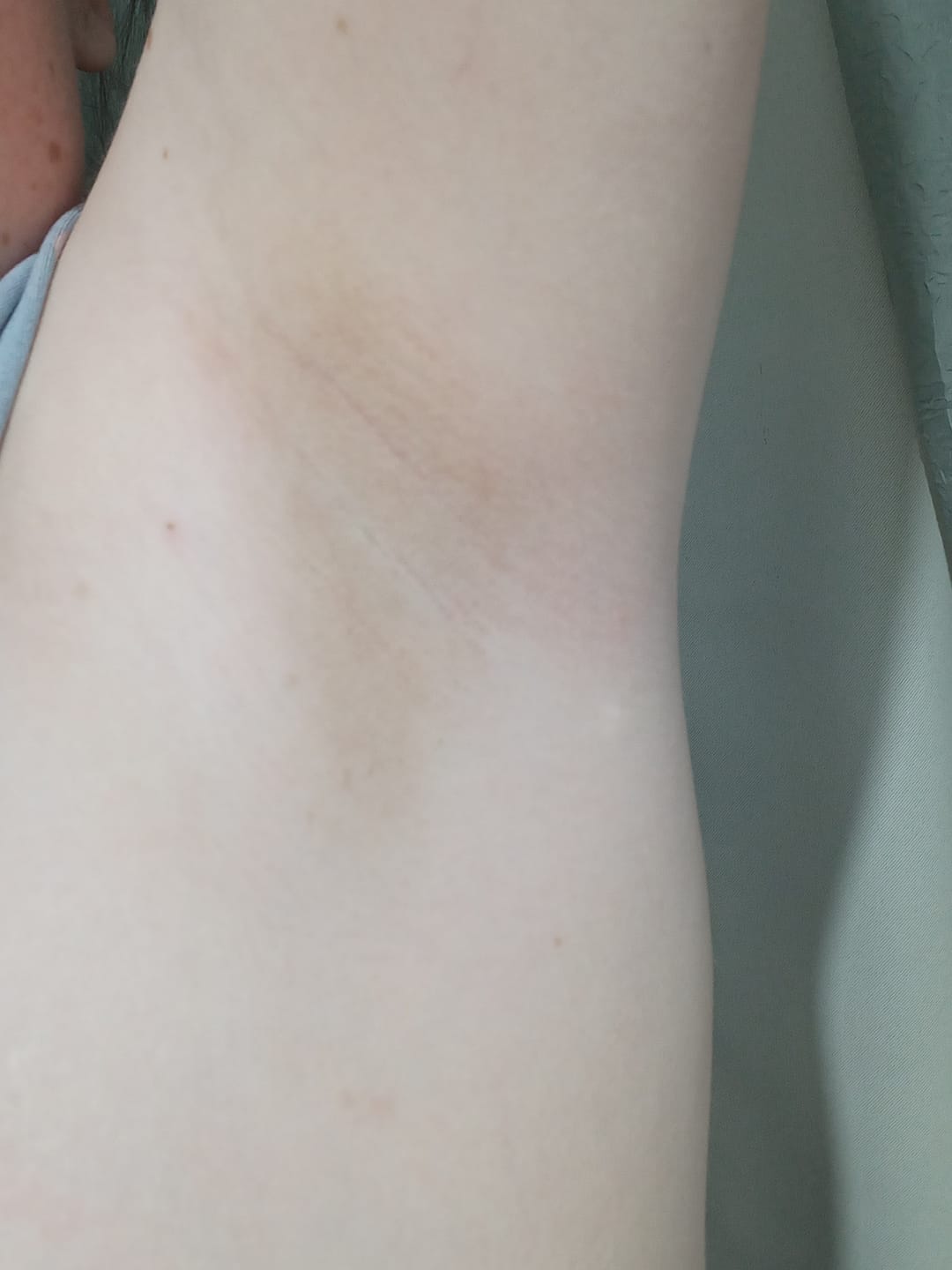 Customer photo review of Creme Clareador de Manchas – Melasma, Axilas, Virilha, Áreas Íntimas, Rosto e Corpo