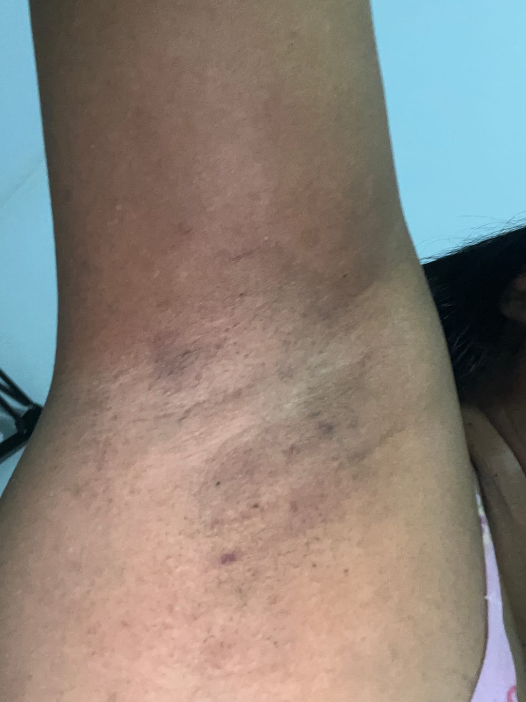 Customer photo review of Creme Clareador de Manchas – Melasma, Axilas, Virilha, Áreas Íntimas, Rosto e Corpo