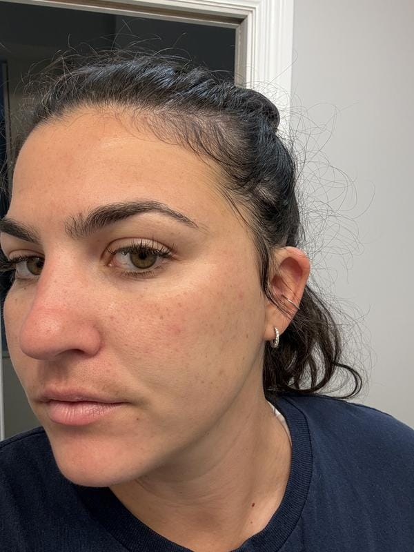 Customer photo review of Instant FIRMx® Peter Thomas Roth Tensor de Ojos Temporal