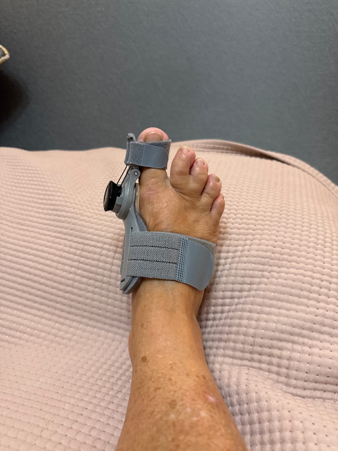 Customer photo review of OrtoWell™ Tåstöd - Naturlig smärtlindring för trötta, ömma fötter