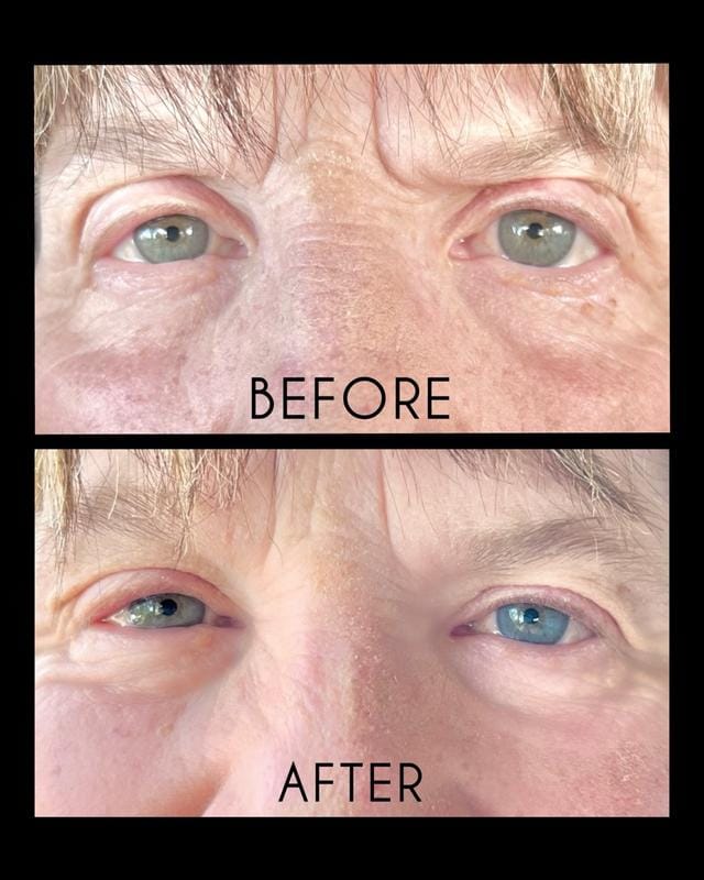Customer photo review of Instant FIRMx® Peter Thomas Roth Tensor de Ojos Temporal