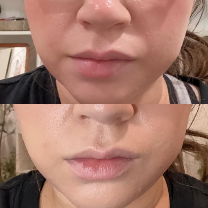 Customer photo review of Instant FIRMx® Peter Thomas Roth Tensor de Ojos Temporal