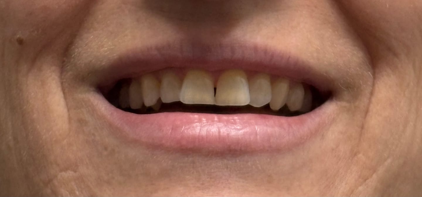 Customer photo review of Pack Gel Violet : 2 Gels Violets Kauka Smile