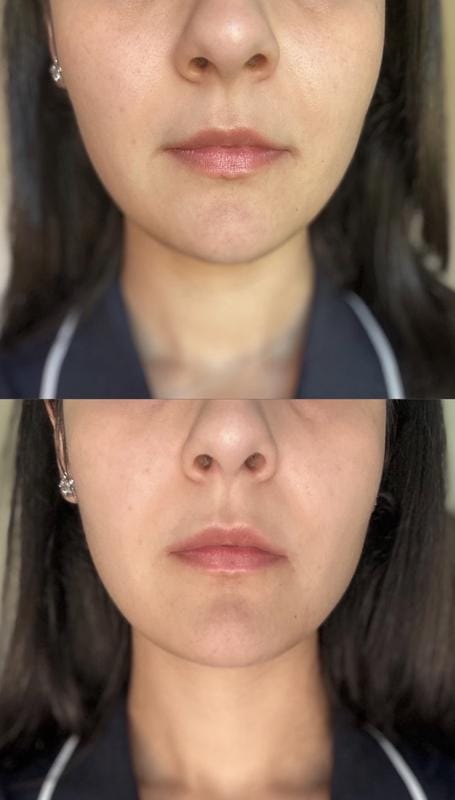 Customer photo review of Instant FIRMx® Peter Thomas Roth Tensor de Ojos Temporal