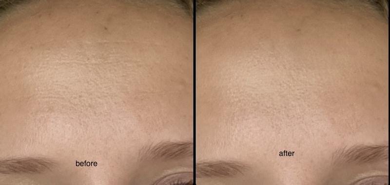 Customer photo review of Instant FIRMx® Peter Thomas Roth Tensor de Ojos Temporal