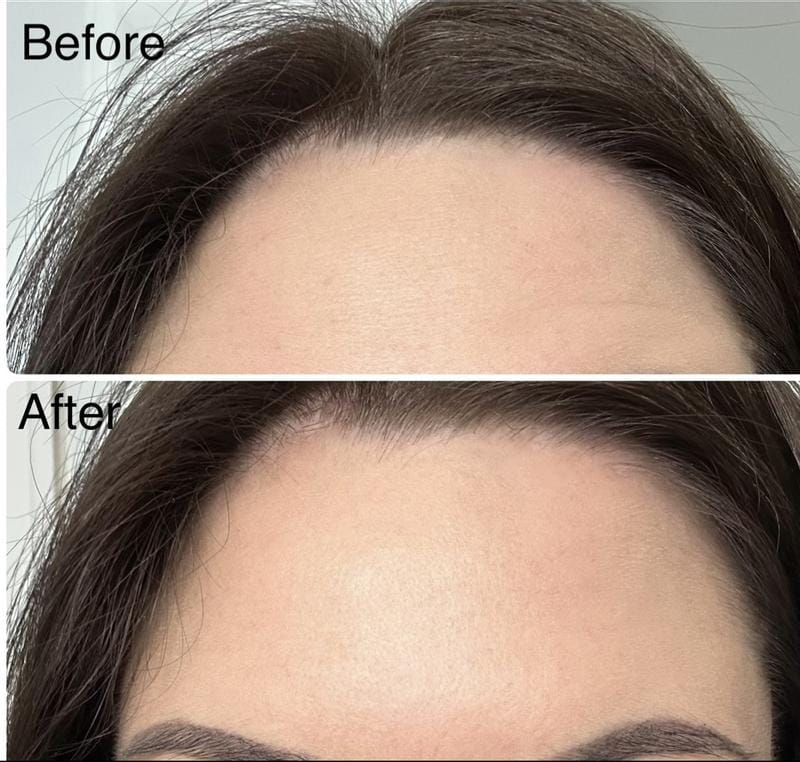 Customer photo review of Instant FIRMx® Peter Thomas Roth Tensor de Ojos Temporal