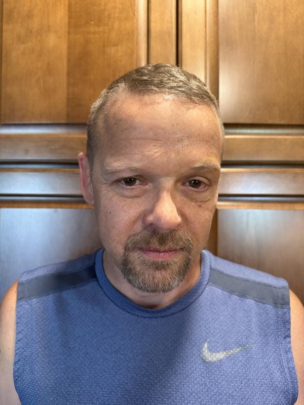 Customer photo review of Instant FIRMx® Peter Thomas Roth Tensor de Ojos Temporal