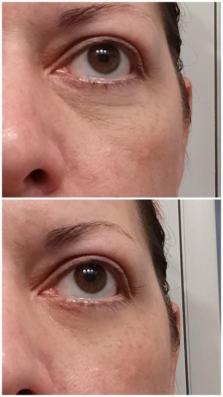 Customer photo review of Instant FIRMx® Peter Thomas Roth Tensor de Ojos Temporal