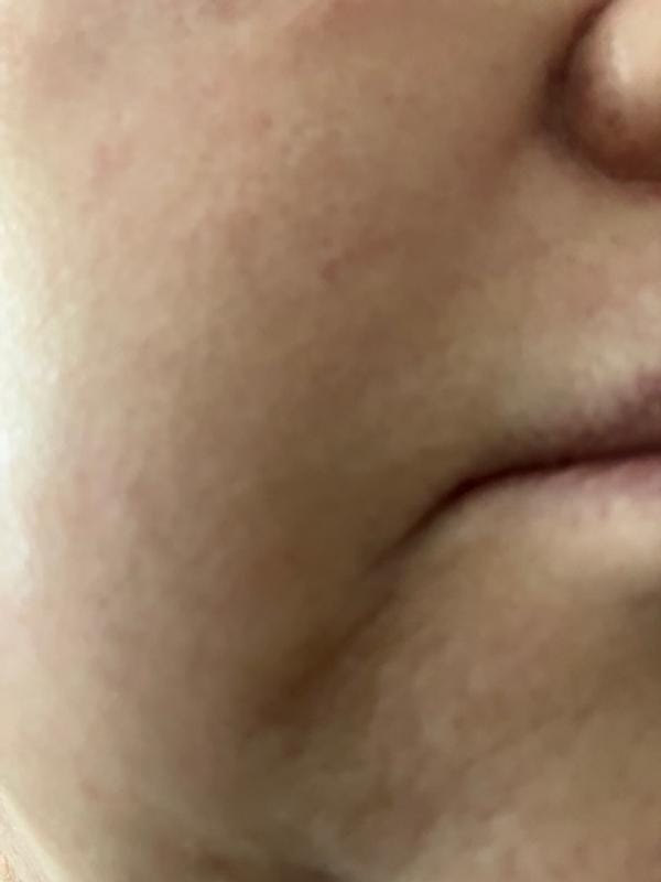 Customer photo review of Instant FIRMx® Peter Thomas Roth Tensor de Ojos Temporal