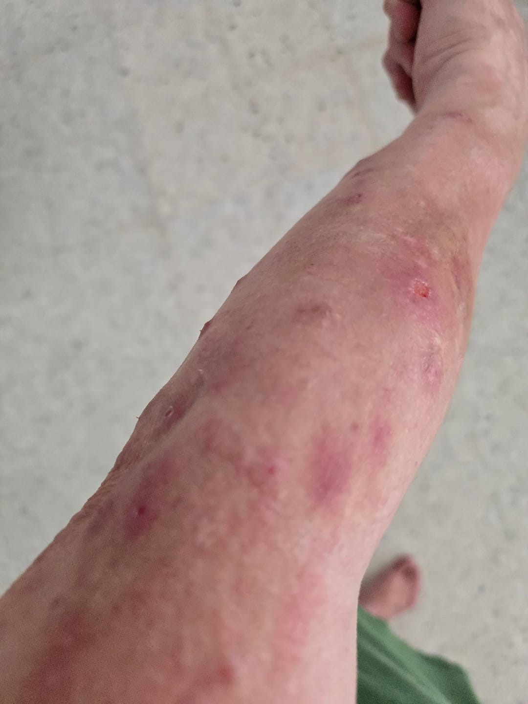 Customer photo review of The Calm and Rebuild Pair (RCV PRO + NVC363) - Calmer, Stronger Skin