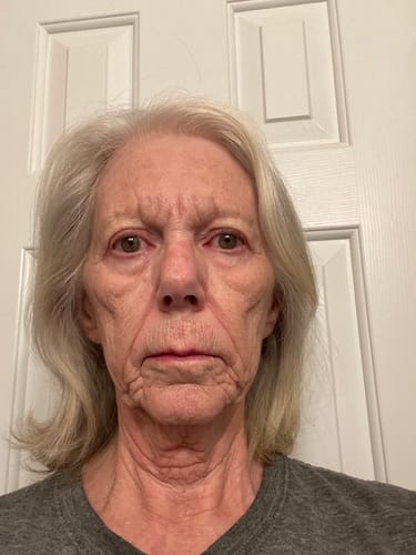 Reviewer's face after using Deep Collagen Cream, showing current skin texture and lines.