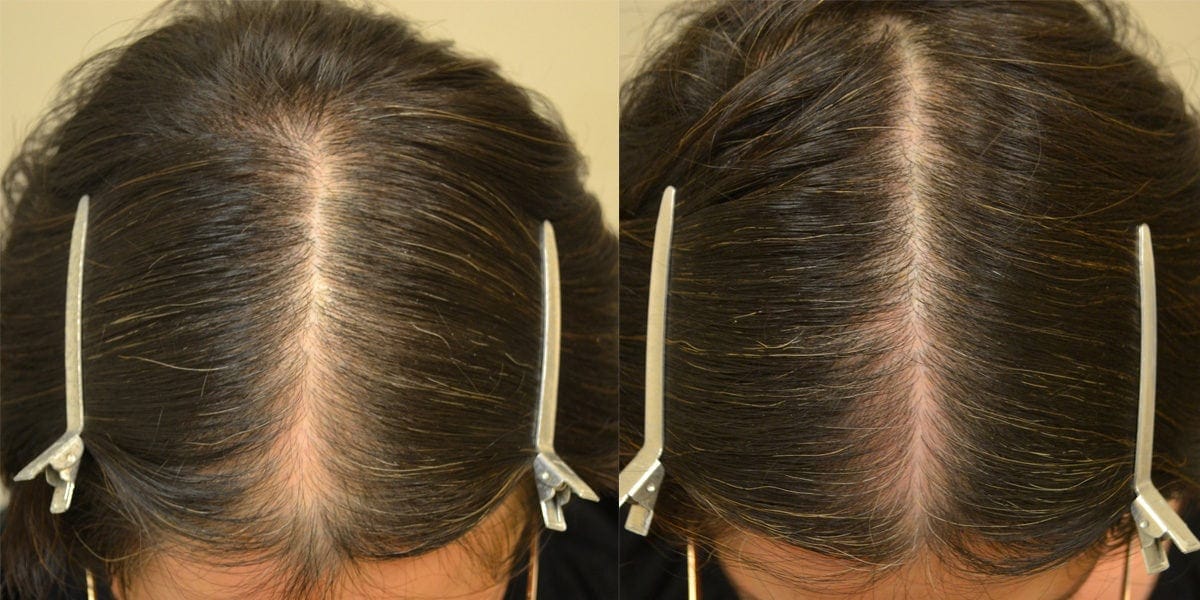 Customer photo review of Nolya Red Light Therapy Hair Brush