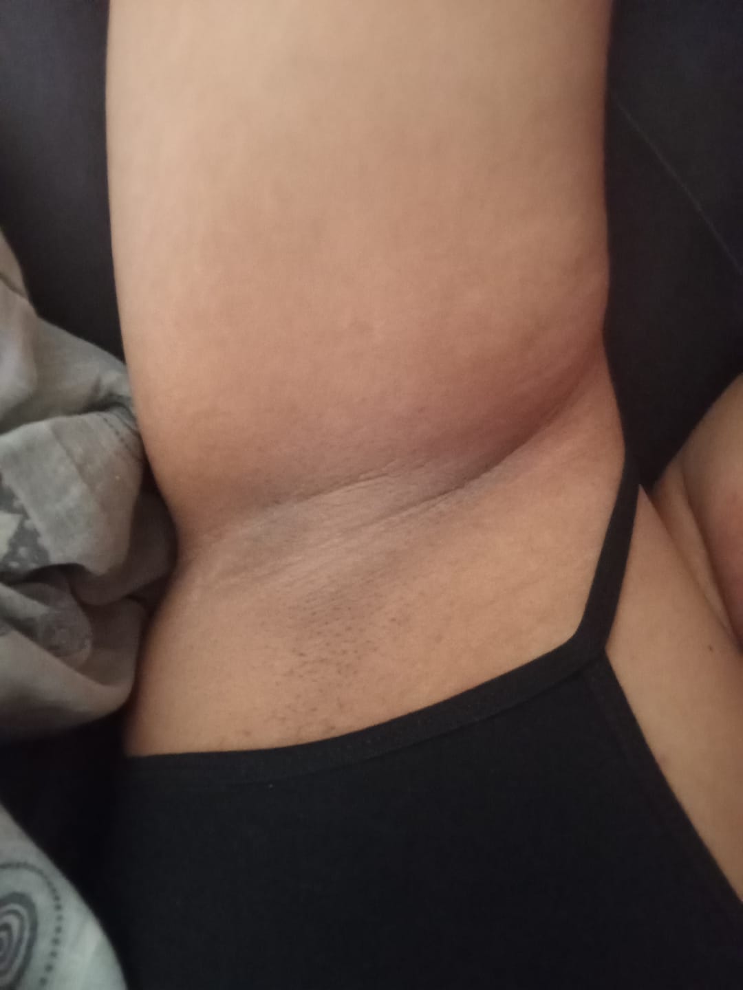 Customer photo review of Creme Clareador de Manchas – Melasma, Axilas, Virilha, Áreas Íntimas, Rosto e Corpo