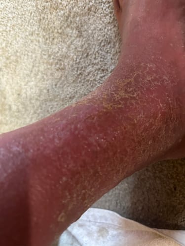 Customer photo review of Duftstofffreie, nicht fettende Anti-Juckreiz-Lotion mit Ceramid NP für trockene, gerötete und empfindliche Haut