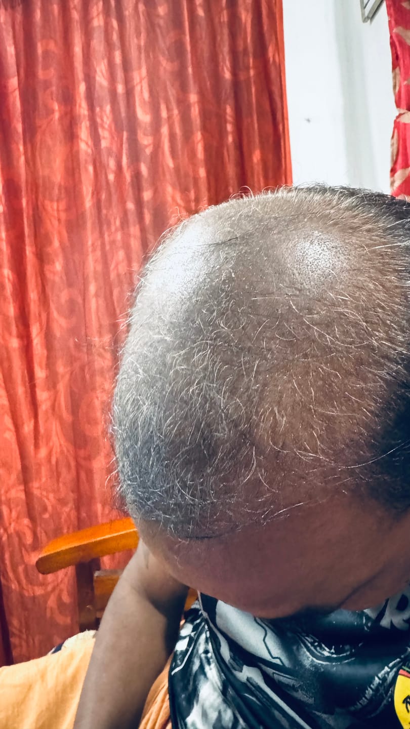 Customer photo review of Advance Hair Growth Serum 2.0 (30ml)